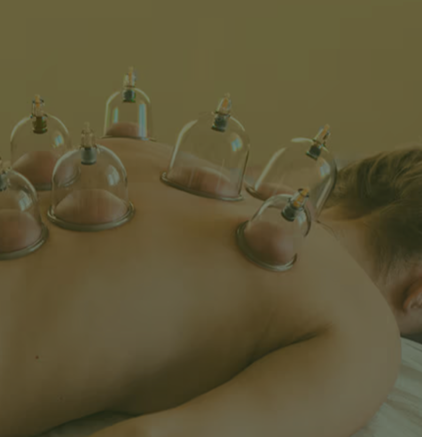 cupping1